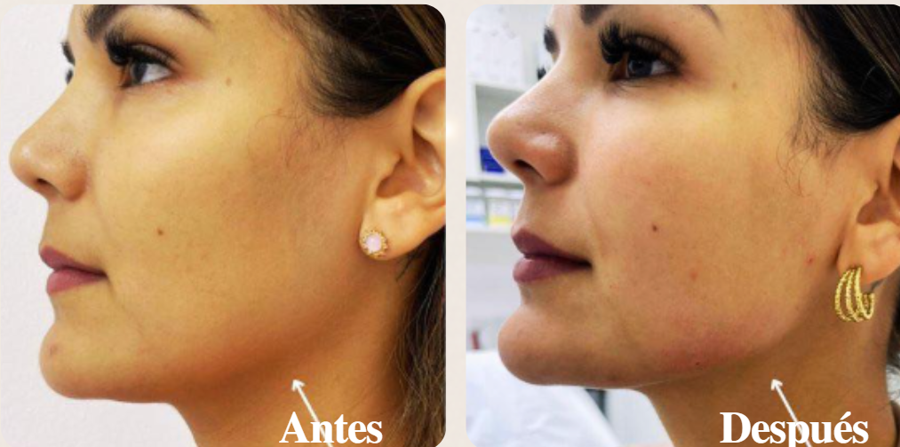 Antes y Después: perfilado facial con hilos tensores en Costa Rica
